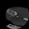 SPORK, NICO - 22.03.1976 - 02.08.2022 - CT obere Extremität - 17:51:17